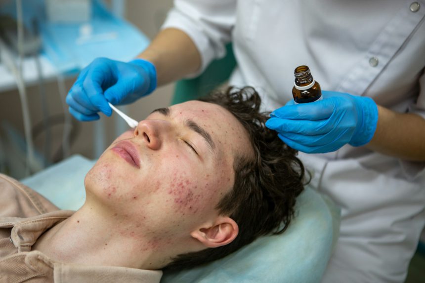 Treatment of acne in adolescents. Facial peeling to fight acne on the face